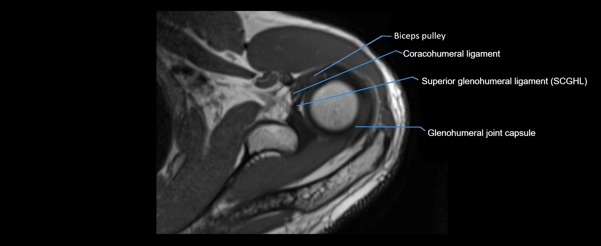 shoulder ligaments axial 3d 3t mri image-img-00005-00045.webp